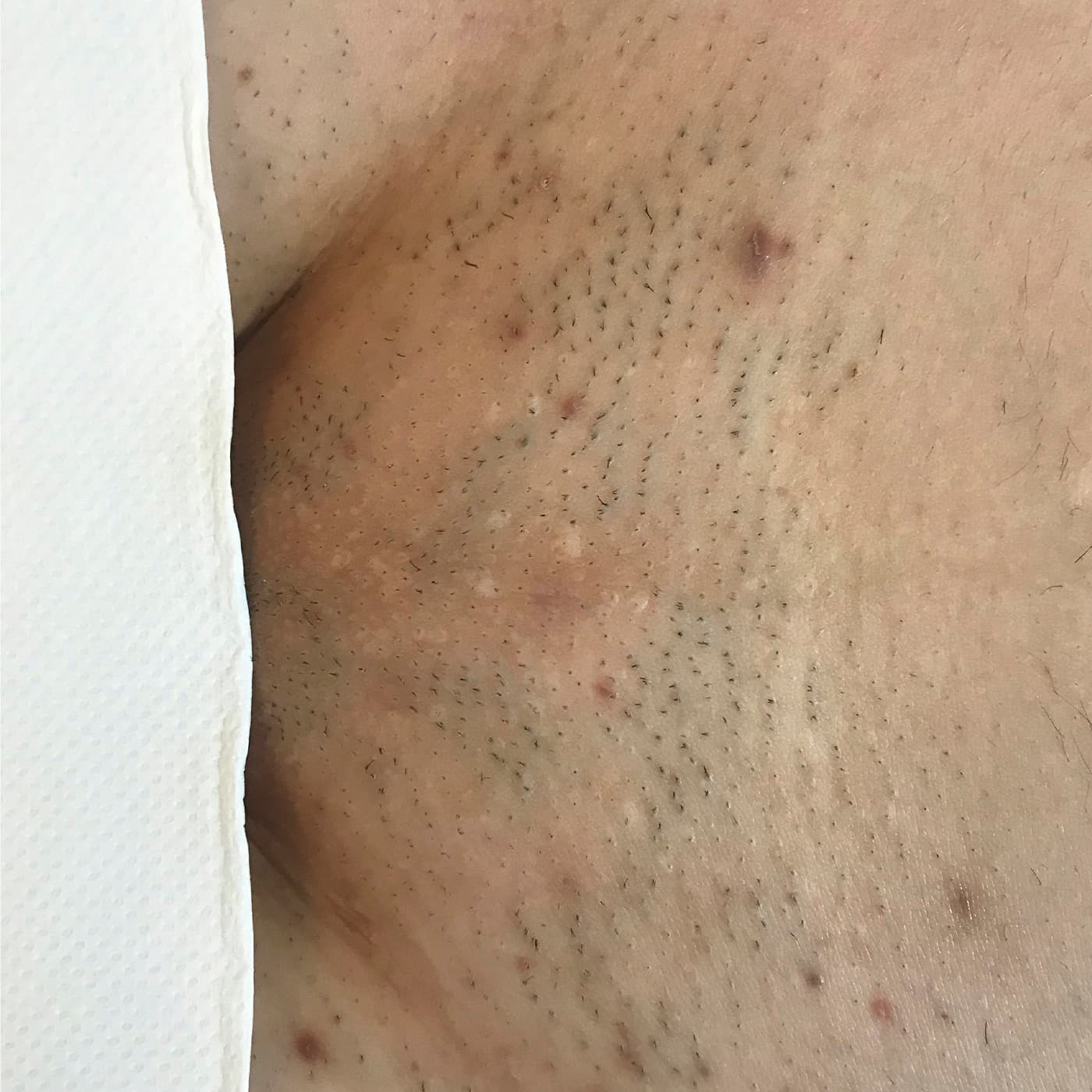 Oblast před laserovou epilací - viditelné chloupky